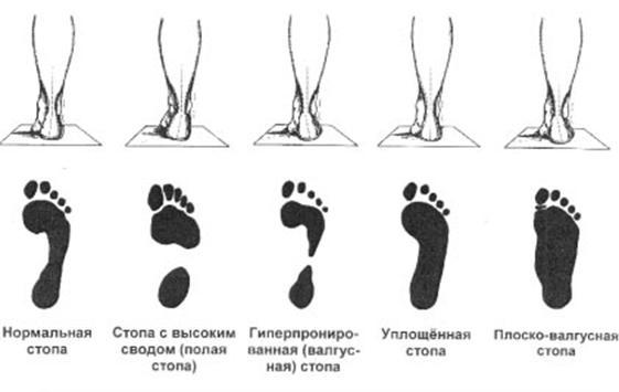 Как выглядит нога с плоскостопием Внимание плоскостопие! - Дошкольное образование - Дошкольникам