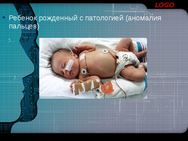 Ребенок рожденный с патологией (аномалия пальцев) 