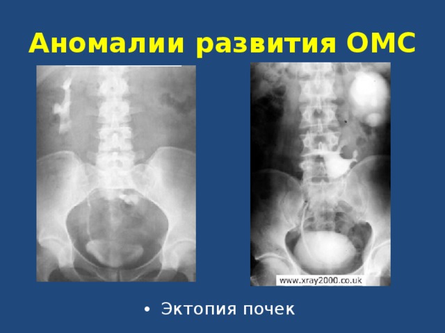 Аномалии развития почки картинки