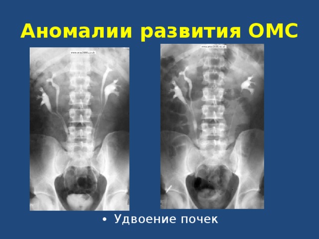 Аномалии развития почки картинки