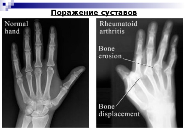 Ревматоидный артрит фото кистей начальная стадия "Ревматоидный артрит. Остеоартрит"