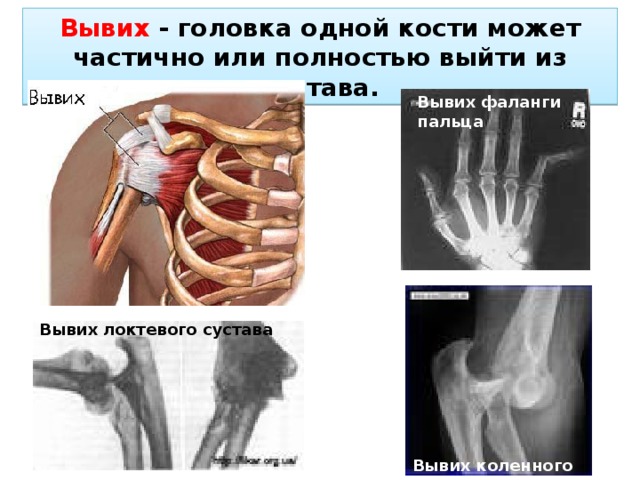 Вывих - головка одной кости может частично или полностью выйти из сустава. Вывих фаланги пальца Вывих локтевого сустава Вывих коленного сустава 