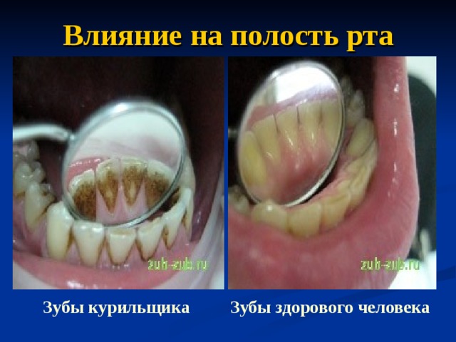 Влияние на полость рта Зубы курильщика Зубы здорового человека 