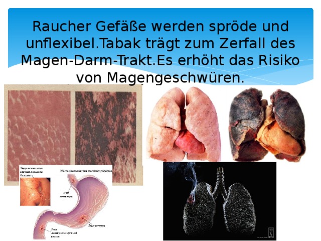    Raucher Gefäße werden spröde und unflexibel.Tabak trägt zum Zerfall des Magen-Darm-Trakt.Es erhöht das Risiko von Magengeschwüren.   