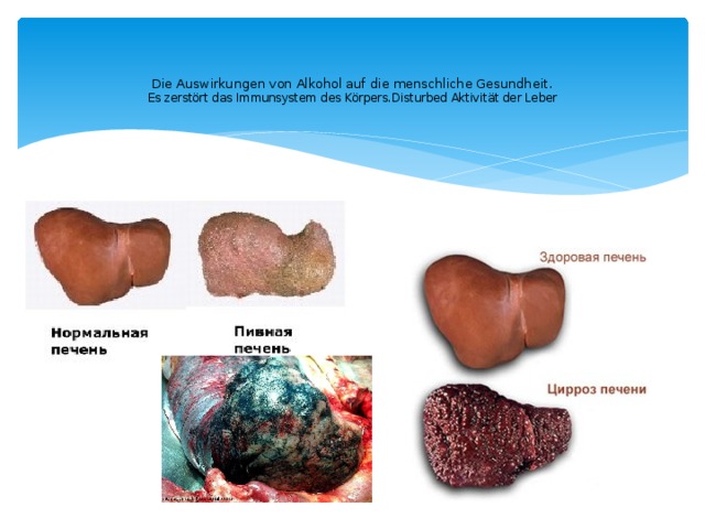     Die Auswirkungen von Alkohol auf die menschliche Gesundheit.  Es zerstört das Immunsystem des Körpers.Disturbed Aktivität der Leber   