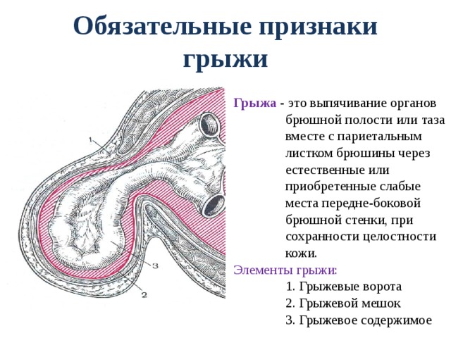 Вентральная грыжа (послеоперационная) – причины, … Foto 18