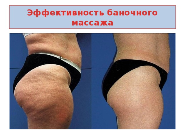 Эффективность баночного массажа 