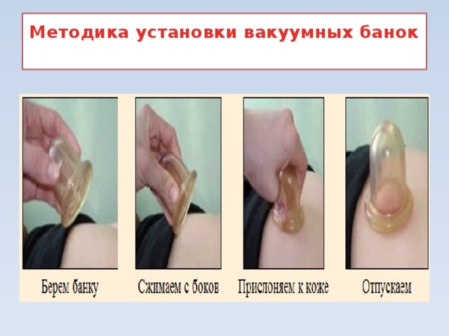 Методика установки вакуумных банок   