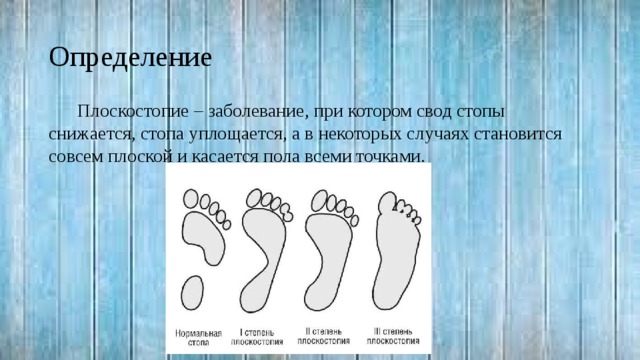 Рассмотрите рисунок с изображением стопы человека как называют нарушение формы