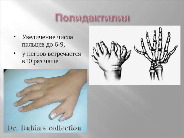 Увеличение числа пальцев до 6-9, у негров встречается в10 раз чаще 