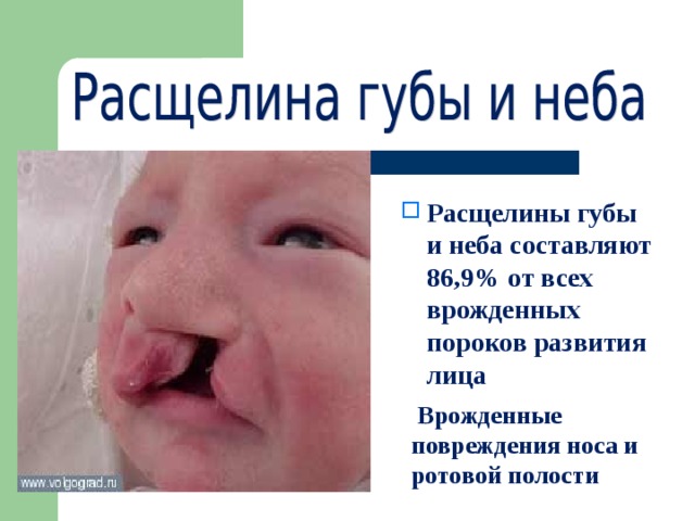 Расщелины губы и неба составляют 86,9% от всех врожденных пороков развития лица  Врожденные повреждения носа и ротовой полости 