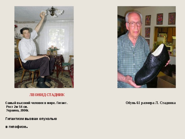  ЛЕОНИД СТАДНИК  Самый высокий человек в мире. Гигант . Обувь 61 размера Л. Стадника  Рост 2м 54 см.  Украина, 2006г.  Гигантизм вызван опухолью в гипофизе .  
