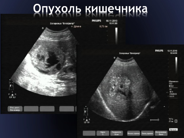 Как выглядит рак кишки снаружи Лучевая диагностика заболеваний желудочно-кишечного тракта