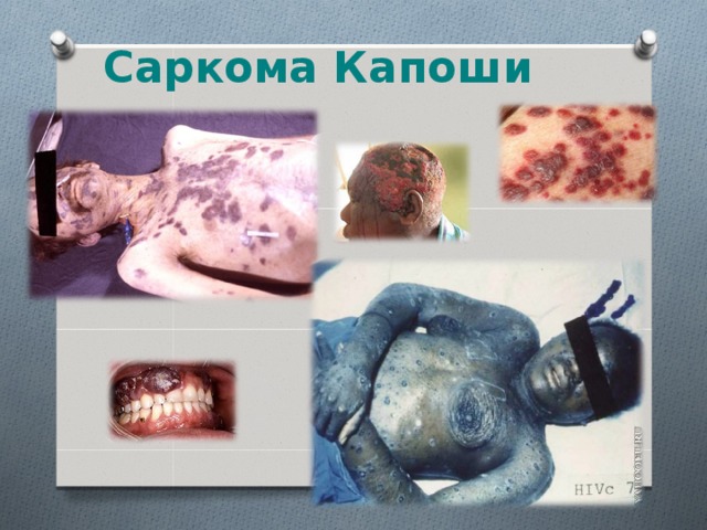 Саркома Капоши 