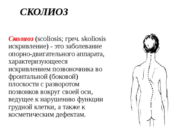 Сколиоз Сколиоз  (scoliosis; греч. skoliosis искривление) - это заболевание опорно-двигательного аппарата, характеризующееся искривлением позвоночника во фронтальной (боковой) плоскости с разворотом позвонков вокруг своей оси, ведущее к нарушению функции грудной клетки, а также к косметическим дефектам. 