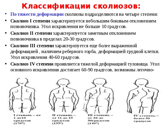 Классификации сколиозов: По тяжести деформации сколиозы подразделяются на четыре степени: Сколиоз I степени характеризуется небольшим боковым отклонением позвоночника. Угол искривления не больше 10 градусов. Сколиоз II степени характеризуется заметным отклонением позвоночника в пределах 20-30 градусов. Сколиоз III степени характеризуется еще более выраженной деформацией , наличием реберного горба, деформацией грудной клетки. Угол искривления 40-60 градусов. Сколиоз IV степени проявляется тяжелой деформацией туловища. Угол основного искривления достигает 60-90 градусов, возможны легочно-сердечные осложнения.  