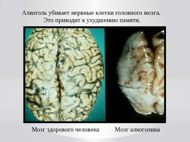 Алкоголь убивает нервные клетки головного мозга. Это приводит к ухудшению памяти. Мозг здорового человека Мозг алкоголика 