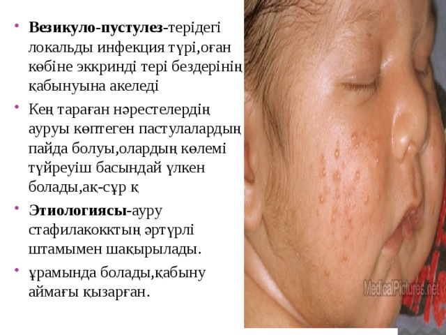 Везикуло-пустулез -терідегі локальды инфекция түрі,оған көбіне эккринді тері бездерінің қабынуына акеледі Кең тараған нәрестелердің ауруы көптеген пастулалардың пайда болуы,олардың көлемі түйреуіш басындай үлкен болады,ақ-сұр қ Этиологиясы -ауру стафилакокктың әртүрлі штамымен шақырылады. ұрамында болады,қабыну аймағы қызарған . 