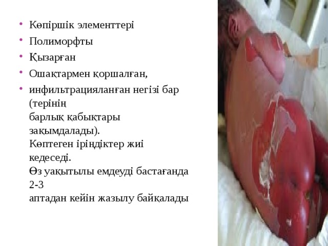 Көпіршік элементтері Полиморфты Қызарған Ошақтармен қоршалған, инфильтрацияланған негізі бар (терінің  барлық қабықтары зақымдалады).  Көптеген іріңдіктер жиі кедеседі.  Өз уақытылы емдеуді бастағанда 2-3  аптадан кейін жазылу байқалады   