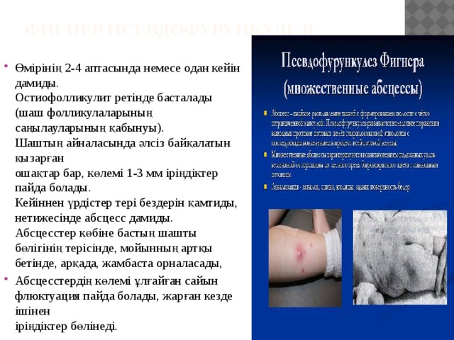 Фигнер псевдофурункулезі    Өмірінің 2-4 аптасында немесе одан кейін дамиды.  Остиофолликулит ретінде басталады  (шаш фолликулаларының  саңылауларының қабынуы).  Шаштың айналасында әлсіз байқалатын қызарған  ошақтар бар, көлемі 1-3 мм іріңдіктер пайда болады.  Кейіннен үрдістер тері бездерін қамтиды, нетижесінде абсцесс дамиды.  Абсцесстер көбіне бастың шашты бөлігінің терісінде, мойынның артқы бетінде, арқада, жамбаста орналасады, Абсцесстердің көлемі ұлғайған сайын  флюктуация пайда болады, жарған кезде ішінен  іріңдіктер бөлінеді.   