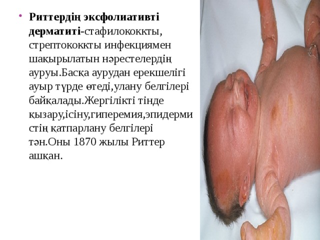 Риттердің эксфолиативті дерматиті -стафилококкты, стрептококкты инфекциямен шақырылатын нәрестелердің ауруы.Басқа аурудан ерекшелігі ауыр түрде өтеді,улану белгілері байқалады.Жергілікті тінде қызару,ісіну,гиперемия,эпидермистің қатпарлану белгілері тән.Оны 1870 жылы Риттер ашқан. 