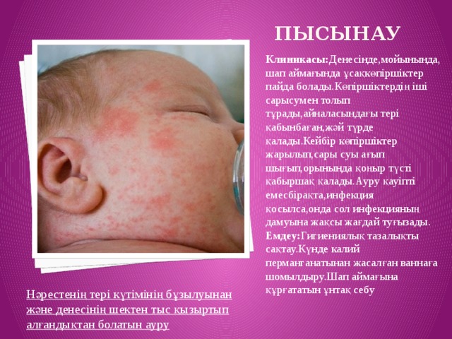 Пысынау Клиникасы: Денесінде,мойынында,шап аймағында ұсақкөпіршіктер пайда болады.Көпіршіктердің іші сарысумен толып тұрады,айналасындағы тері қабынбаған,жәй түрде қалады.Кейбір көпіршіктер жарылып,сары суы ағып шығып,орынында қоңыр түсті қабыршақ қалады.Ауру қауіпті емесбірақта,инфекция қосылса,онда сол инфекцияның дамуына жақсы жағдай туғызады. Емдеу: Гигиениялық тазалықты сақтау.Күнде калий перманганатынан жасалған ваннаға шомылдыру.Шап аймағына құрғататын ұнтақ себу Нәрестенің тері күтімінің бұзылуынан және денесінің шектен тыс қызыртып алғандықтан болатын ауру 