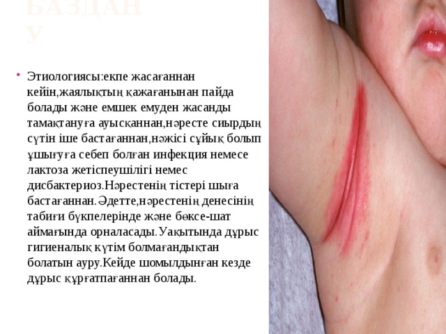Баздану Этиологиясы:екпе жасағаннан кейін,жаялықтың қажағанынан пайда болады және емшек емуден жасанды тамақтануға ауысқаннан,нәресте сиырдың сүтін іше бастағаннан,нәжісі сұйық болып ұшығуға себеп болған инфекция немесе лактоза жетіспеушілігі немес дисбактериоз.Нәрестенің тістері шыға бастағаннан.Әдетте,нәрестенің денесінің табиғи бүкпелерінде және бөксе-шат аймағында орналасады.Уақытында дұрыс гигиеналық күтім болмағандықтан болатын ауру.Кейде шомылдынған кезде дұрыс құрғатпағаннан болады. 
