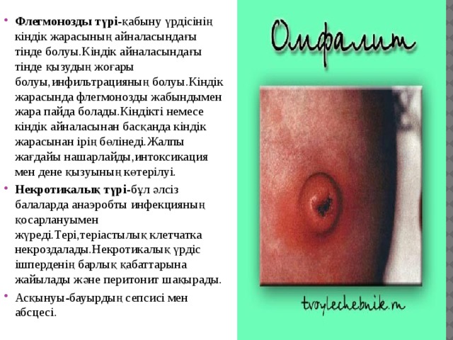 Флегмонозды түрі -қабыну үрдісінің кіндік жарасының айналасындағы тінде болуы.Кіндік айналасындағы тінде қызудың жоғары болуы,инфильтрацияның болуы.Кіндік жарасында флегмонозды жабындымен жара пайда болады.Кіндікті немесе кіндік айналасынан басқанда кіндік жарасынан ірің бөлінеді.Жалпы жағдайы нашарлайды,интоксикация мен дене қызуының көтерілуі. Некротикалық түрі -бұл әлсіз балаларда анаэробты инфекцияның қосарлануымен жүреді.Тері,теріастылық клетчатка некроздалады.Некротикалық үрдіс ішперденің барлық қабаттарына жайылады және перитонит шақырады. Асқынуы-бауырдың сепсисі мен абсцесі. 