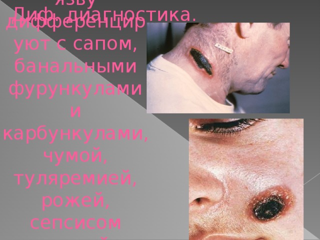 Диф. диагностика. Сибирскую язву дифференцируют с сапом, банальными фурункулами и карбункулами, чумой, туляремией, рожей, сепсисом другой этиологии.  