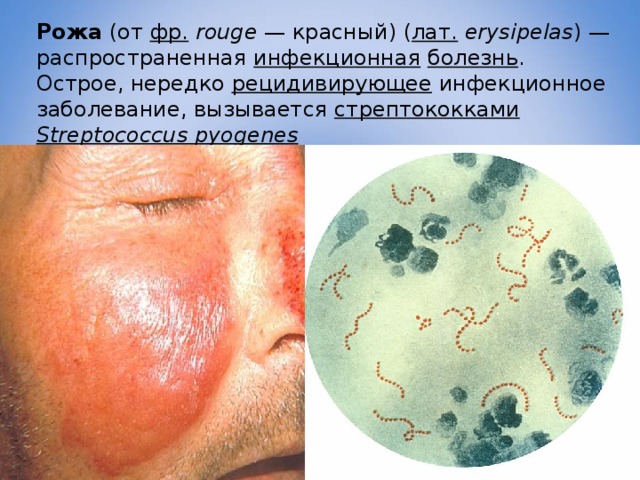 Рожа (от фр.  rouge — красный) ( лат.  erysipelas ) — распространенная инфекционная  болезнь . Острое, нередко рецидивирующее инфекционное заболевание, вызывается стрептококками  Streptococcus pyogenes 