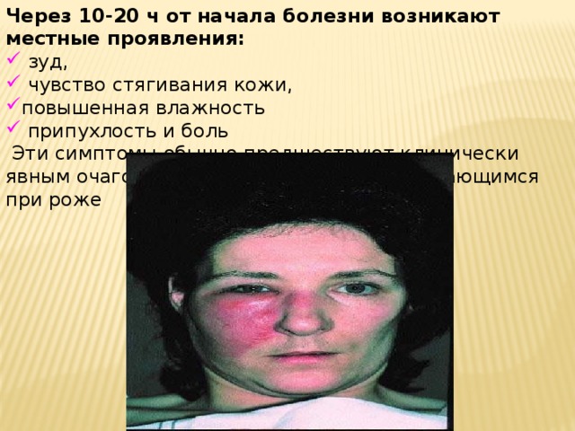 Через 10-20 ч от начала болезни возникают местные проявления:  зуд,  чувство стягивания кожи, повышенная влажность  припухлость и боль  Эти симптомы обычно предшествуют клинически явным очаговым изменениям кожи, развивающимся при роже 
