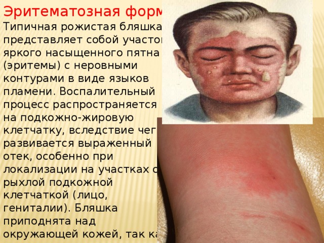 Эритематозная форма . Типичная рожистая бляшка представляет собой участок яркого насыщенного пятна (эритемы) с неровными контурами в виде языков пламени. Воспалительный процесс распространяется на подкожно-жировую клетчатку, вследствие чего развивается выраженный отек, особенно при локализации на участках с рыхлой подкожной клетчаткой (лицо, гениталии). Бляшка приподнята над окружающей кожей, так как отграничена от неизмененной кожи краевым валиком, при этом центр ее как бы западает 