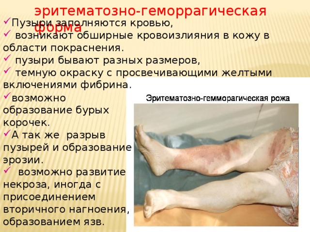 эритематозно-геморрагическая форма Пузыри заполняются кровью,  возникают обширные кровоизлияния в кожу в области покраснения.  пузыри бывают разных размеров,  темную окраску с просвечивающими желтыми включениями фибрина. возможно образование бурых корочек. А так же разрыв пузырей и образование эрозии.  возможно развитие некроза, иногда с присоединением вторичного нагноения, образованием язв. 
