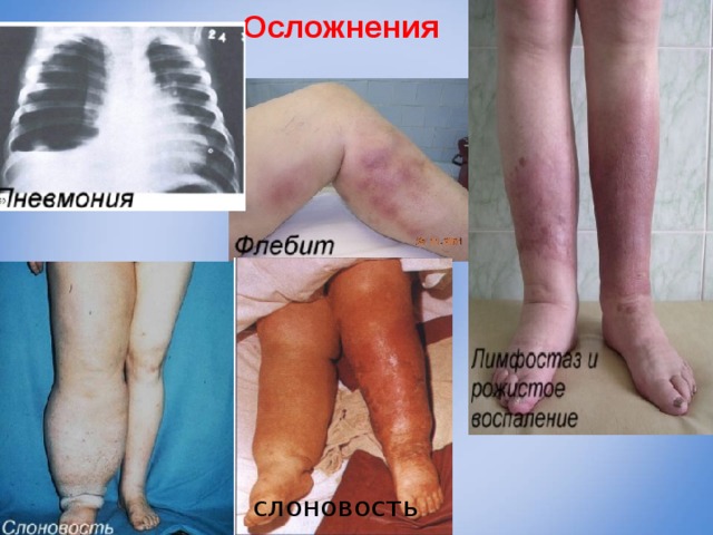Осложнения       слоновость 