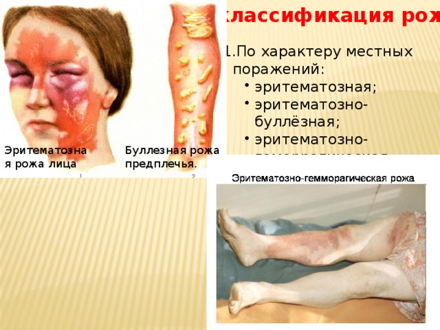  классификация рожи  По характеру местных поражений: По характеру местных поражений: эритематозная; эритематозно-буллёзная; эритематозно-геморрагическая; эритематозная; эритематозно-буллёзная; эритематозно-геморрагическая; эритематозная; эритематозно-буллёзная; эритематозно-геморрагическая; Эритематозная рожа лица Буллезная рожа предплечья. 