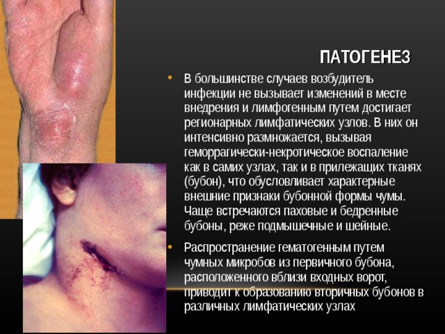 ПАТОГЕНЕЗ В большинстве случаев возбудитель инфекции не вызывает изменений в месте внедрения и лимфогенным путем достигает регионарных лимфатических узлов. В них он интенсивно размножается, вызывая геморрагически-некротическое воспаление как в самих узлах, так и в прилежащих тканях (бубон), что обусловливает характерные внешние признаки бубонной формы чумы. Чаще встречаются паховые и бедренные бубоны, реже подмышечные и шейные. Распространение гематогенным путем чумных микробов из первичного бубона, расположенного вблизи входных ворот, приводит к образованию вторичных бубонов в различных лимфатических узлах 