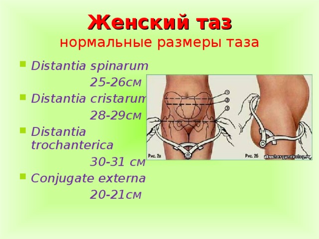 Размеры таза. Distantia spinarum 25–26 см. Нормы объемы таза Акушерство. Наружные Размеры нормального таза. Distantia spinarum в норме.