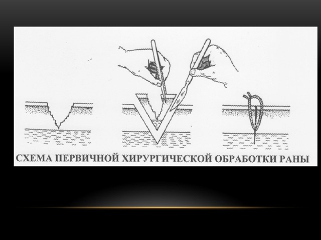 Пхо это. Ранняя первичная хирургическая обработка. Участие в проведении первичной хирургической обработки раны.. Схема первичной хирургической обработки раны.