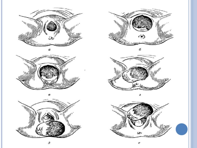 Процесс рождения ребенка. Рождение головки ребенка.