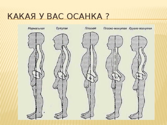 Какая у вас осанка ? 