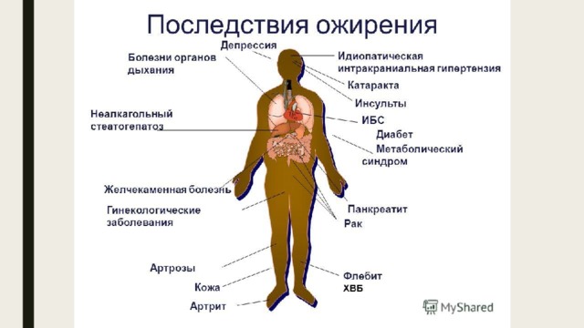 Картинки степени ожирения