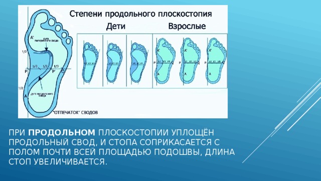 Степени продольного плоскостопия. Продольный свод стопы уплощены. Степень плоскостопия по длине стопы. Своды подошвы. При 3 степени плоскостопия отсутствует продольный свод.