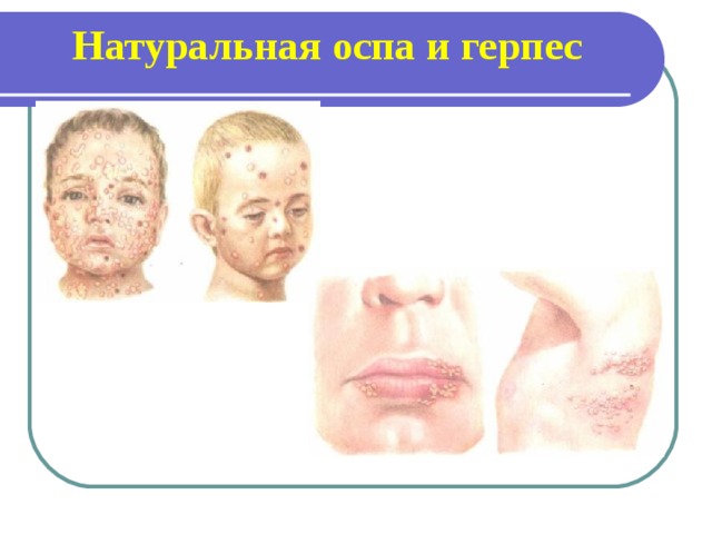 Натуральная оспа  и герпес