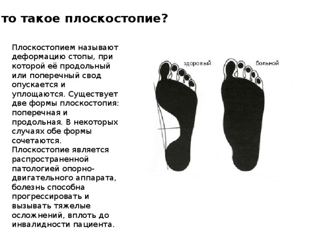 Продольное плоскостопие презентация