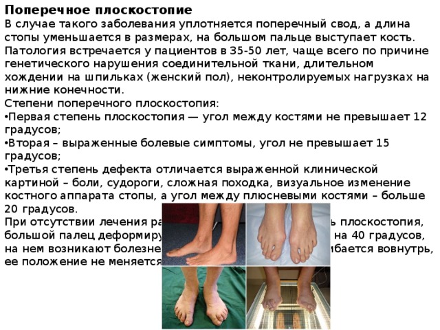Деформация пальцев стопы мкб. Вальгус вальгус плоскостопие. Поперечное плоскостопие и вальгусная деформация. Плосковальгусная стопа мкб 10. Код заболевания плоскостопие.