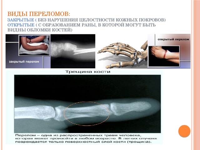  Виды переломов:  закрытые ( без нарушения целостности кожных покровов)  открытые ( с образованием раны, в которой могут быть видны обломки костей)     