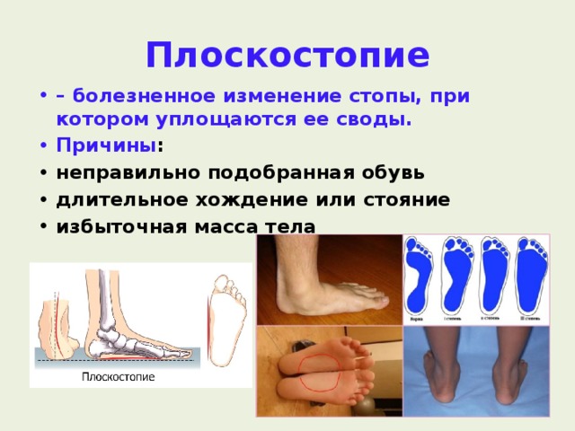 Плоскостопие –  болезненное изменение стопы, при котором уплощаются ее своды. Причины : неправильно подобранная обувь длительное хождение или стояние избыточная масса тела  