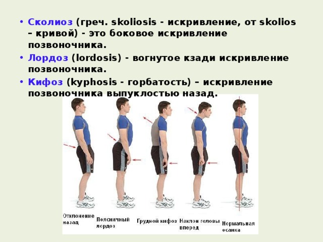 Сколиоз (греч. skoliosis - искривление, от skolios – кривой) - это боковое искривление позвоночника. Лордоз (lordosis) - вогнутое кзади искривление позвоночника. Кифоз (kyphosis - горбатость) – искривление позвоночника выпуклостью назад.  
