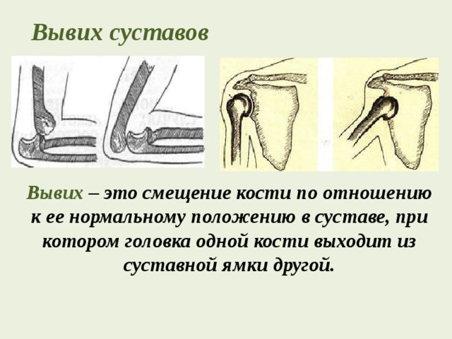 Вывих суставов  Вывих – это смещение кости по отношению к ее нормальному положению в суставе, при котором головка одной кости выходит из суставной ямки другой. 
