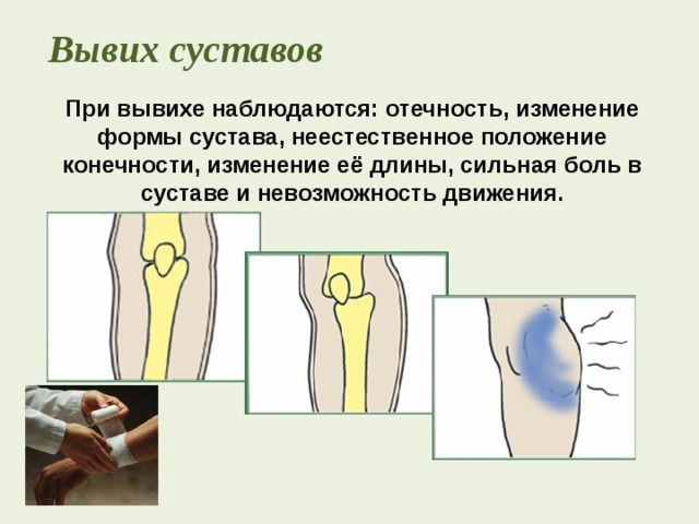 Изменение формы сустава. Перелом костей коленного сустава карта вызова. Подвывих коленного сустава.